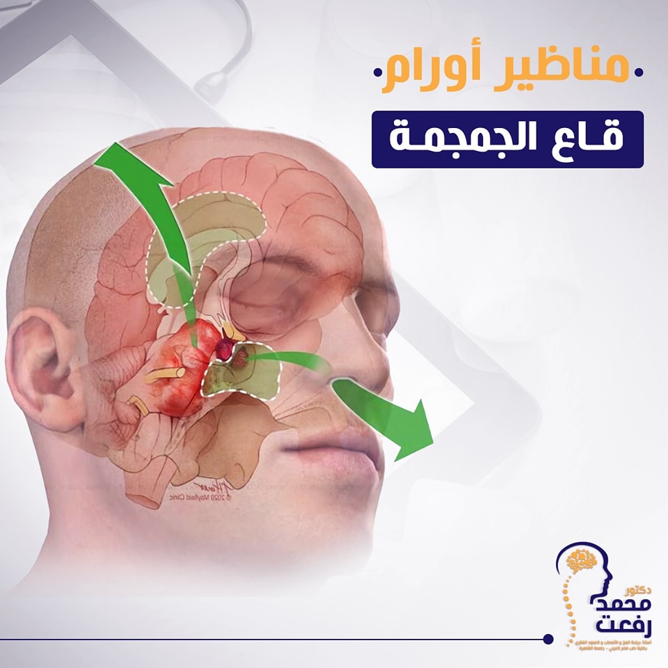 مناظير جراحة قاع الجمجمة