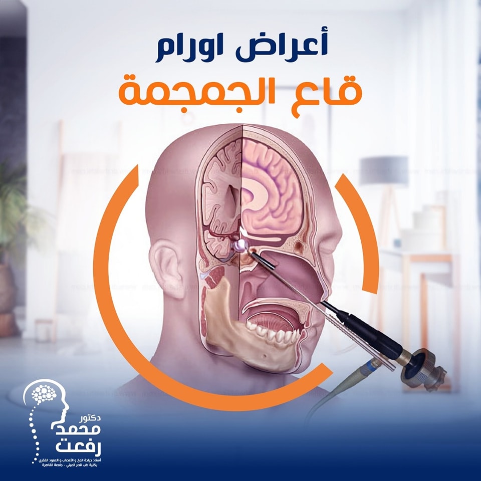 اورام قاع الجمجمة