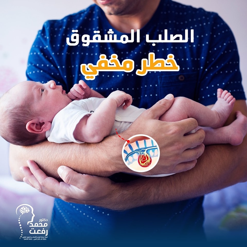 الصلب المشقق